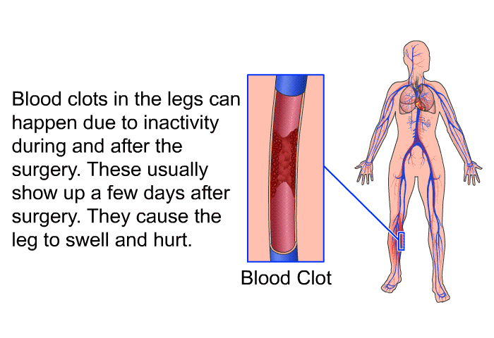 Blood clots in the legs can happen due to inactivity during and after the surgery. These usually show up a few days after surgery. They cause the leg to swell and hurt.