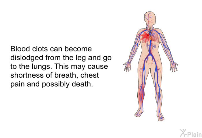 Blood clots can become dislodged from the leg and go to the lungs. This may cause shortness of breath, chest pain and possibly death.