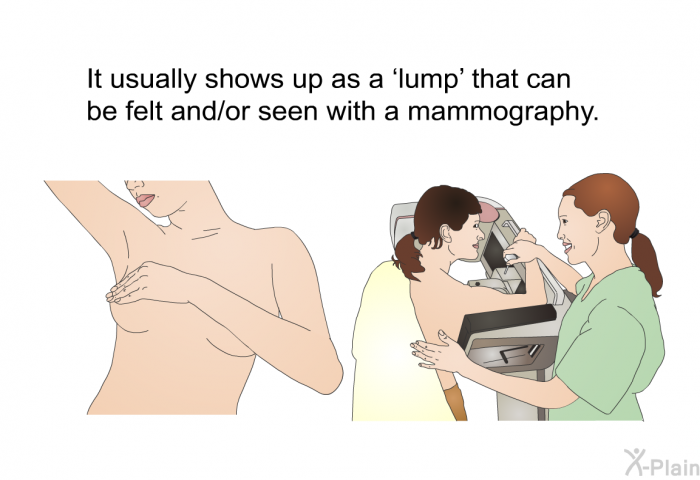 It usually shows up as a  lump' that can be felt and/or seen with a mammography.