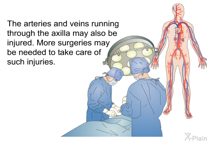 The arteries and veins running through the axilla may also be injured. More surgeries may be needed to take care of such injuries.