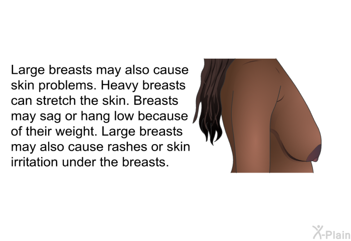 Large breasts may also cause skin problems. Heavy breasts can stretch the skin. Breasts may sag or hang low because of their weight. Large breasts may also cause rashes or skin irritation under the breasts.