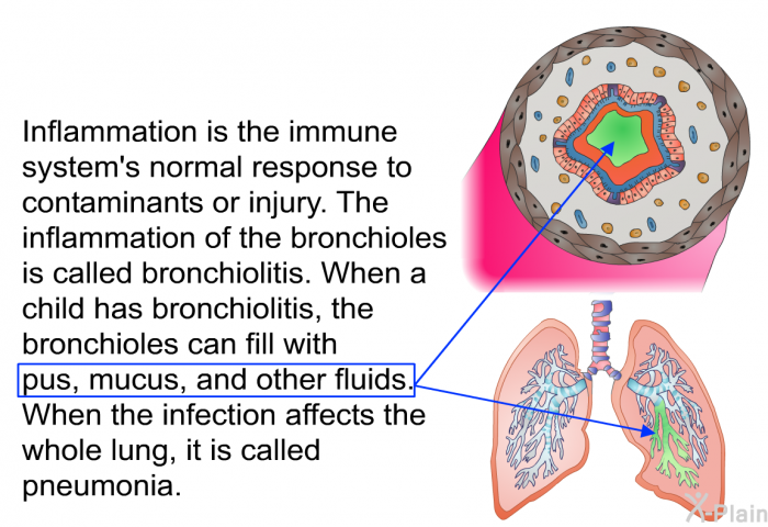 Inflammation is the immune system's normal response to contaminants or injury. The inflammation of the bronchioles is called bronchiolitis. When a child has bronchiolitis, the bronchioles can fill with pus, mucus, and other fluids. When the infection affects the whole lung, it is called pneumonia.