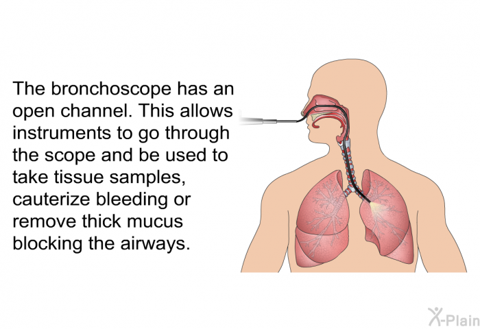 The bronchoscope has an open channel. This allows instruments to go through the scope and be used to take tissue samples, cauterize bleeding or remove thick mucus blocking the airways.
