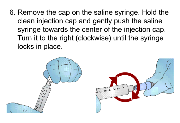 Remove the cap on the saline syringe. Hold the clean injection cap and gently push the saline syringe towards the center of the injection cap. Turn it to the right (clockwise) until the syringe locks in place.