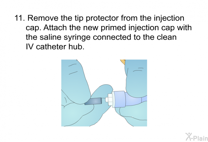 Remove the tip protector from the injection cap. Attach the new primed injection cap with the saline syringe connected to the clean IV catheter hub.