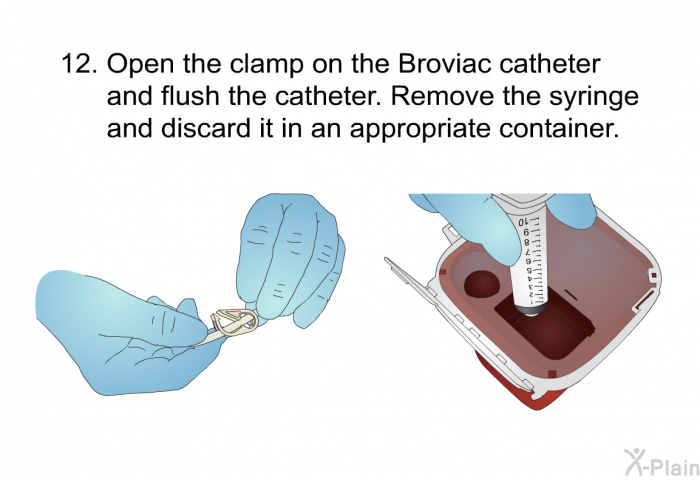 <OL START=12> Open the clamp on the Broviac catheter and flush the catheter. Remove the syringe and discard it in an appropriate container.
