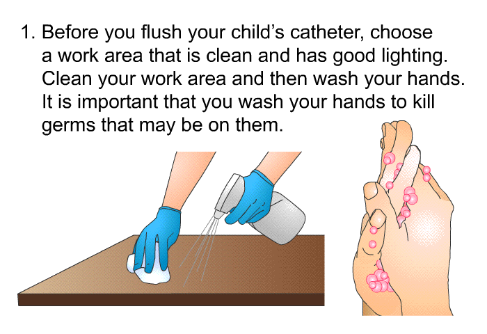 Before you flush your child’s catheter, choose a work area that is clean and has good lighting. Clean your work area and then wash your hands. It is important that you wash your hands to kill germs that may be on them.