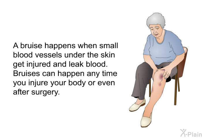 A bruise happens when small blood vessels under the skin get injured and leak blood. Bruises can happen any time you injure your body or even after surgery.