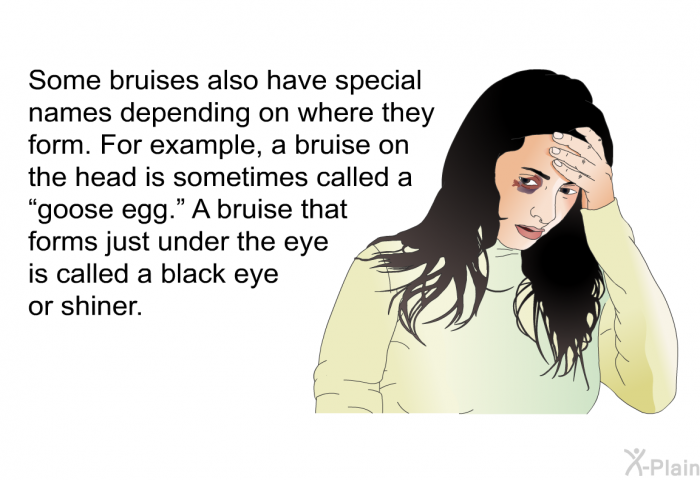 Some bruises also have special names depending on where they form. For example, a bruise on the head is sometimes called a “goose egg.” A bruise that forms just under the eye is called a black eye or shiner.