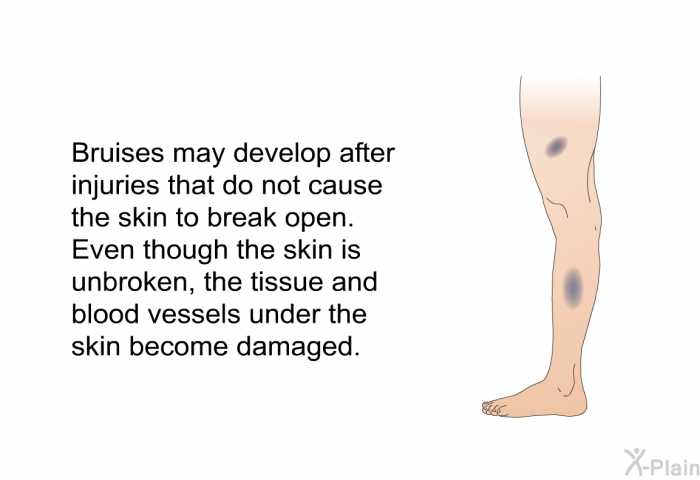 Bruises may develop after injuries that do not cause the skin to break open. Even though the skin is unbroken, the tissue and blood vessels under the skin become damaged.