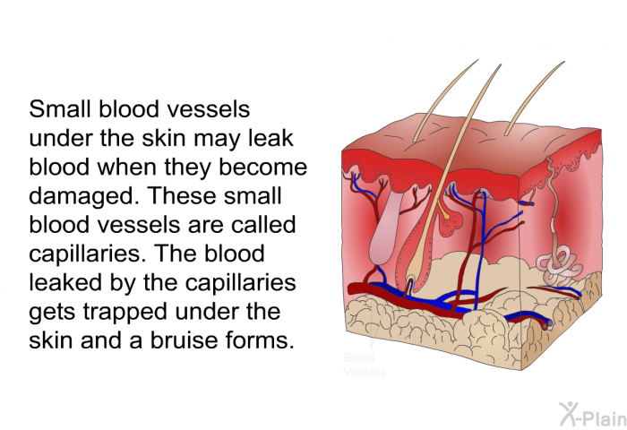 Small blood vessels under the skin may leak blood when they become damaged. These small blood vessels are called capillaries. The blood leaked by the capillaries gets trapped under the skin and a bruise forms.