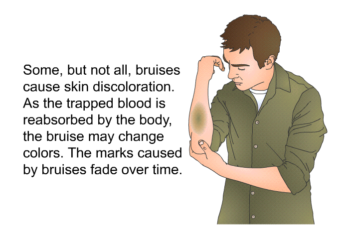 Some, but not all, bruises cause skin discoloration. As the trapped blood is reabsorbed by the body, the bruise may change colors. The marks caused by bruises fade over time.