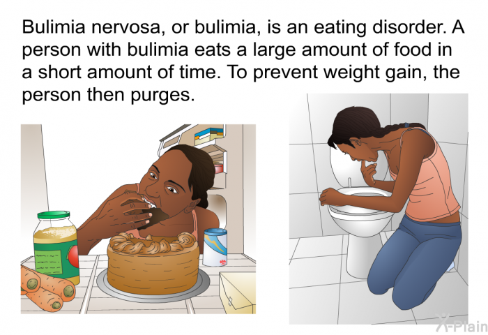 Bulimia nervosa, or bulimia, is an eating disorder. A person with bulimia eats a large amount of food in a short amount of time. To prevent weight gain, the person then purges.