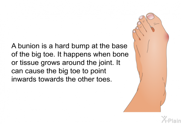 A bunion is a hard bump at the base of the big toe. It happens when bone or tissue grows around the joint. It can cause the big toe to point inwards towards the other toes.