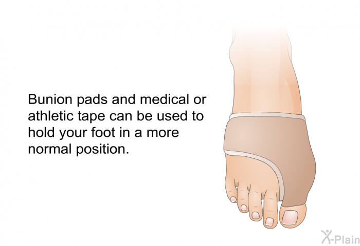 Bunion pads and medical or athletic tape can be used to hold your foot in a more normal position.