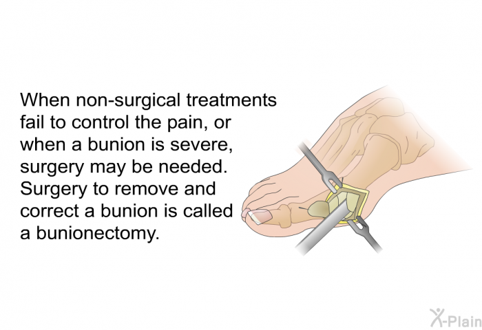 When non-surgical treatments fail to control the pain, or when a bunion is severe, surgery may be needed. Surgery to remove and correct a bunion is called a bunionectomy.