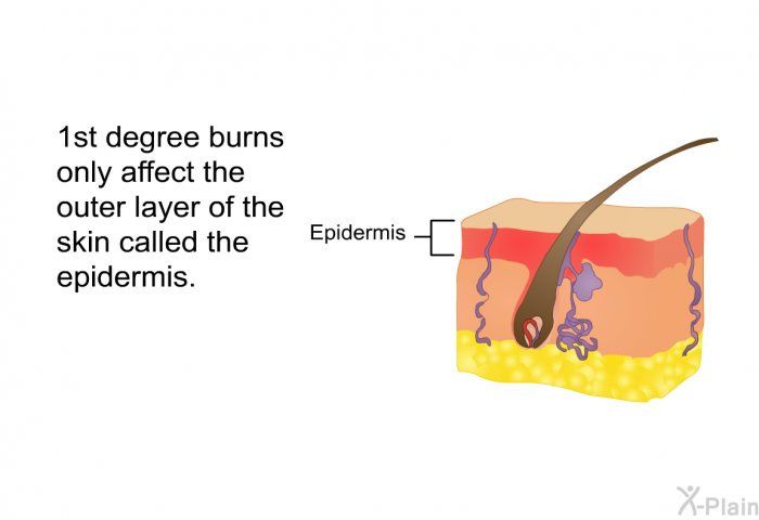 1st degree burns only affect the outer layer of the skin called the epidermis.