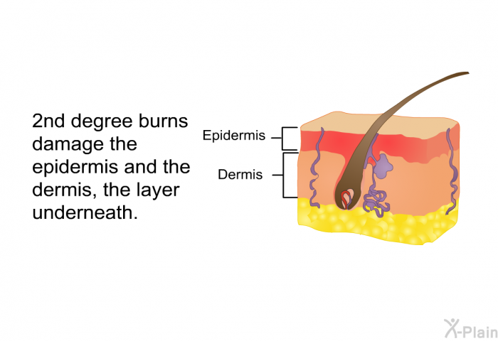 2<SUP>nd</SUP> degree burns damage the epidermis and the dermis, the layer underneath.