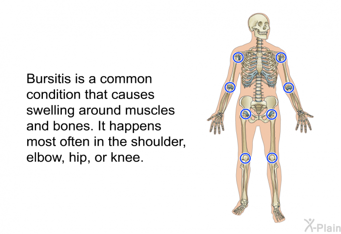 Bursitis is a common condition that causes swelling around muscles and bones. It happens most often in the shoulder, elbow, hip, or knee.