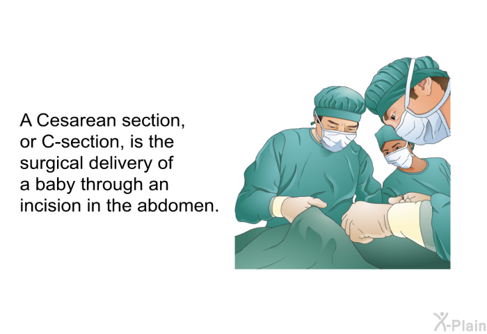 A Cesarean section, or C-section, is the surgical delivery of a baby through an incision in the abdomen.