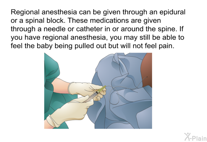 Regional anesthesia can be given through an epidural or a spinal block. These medications are given through a needle or catheter in or around the spine. If you have regional anesthesia, you may still be able to feel the baby being pulled out but will not feel pain.