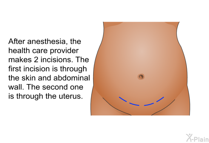 After anesthesia, a health care provider makes 2 incisions. The first incision is through the skin and abdominal wall. The second one is through the uterus.