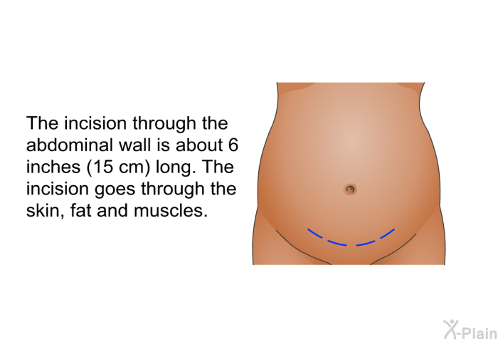 The incision through the abdominal wall is about 6 inches (15 cm) long. The incision goes through the skin, fat and muscles.
