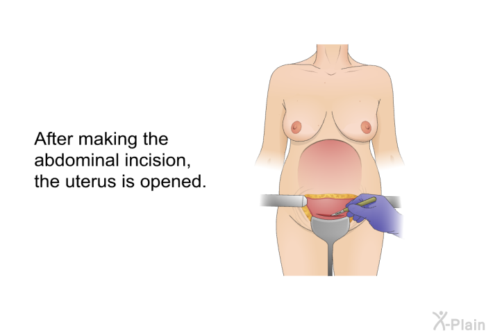 After making the abdominal incision, the uterus is opened.