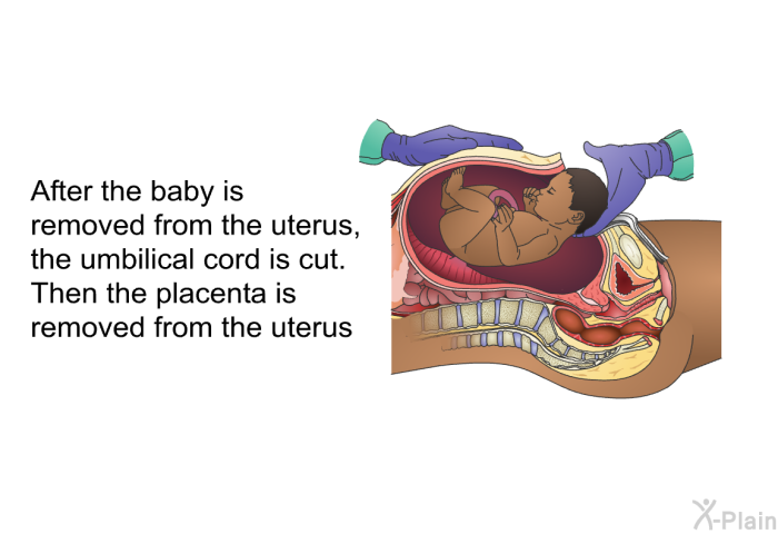 After the baby is removed from the uterus, the umbilical cord is cut. Then the placenta is removed from the uterus