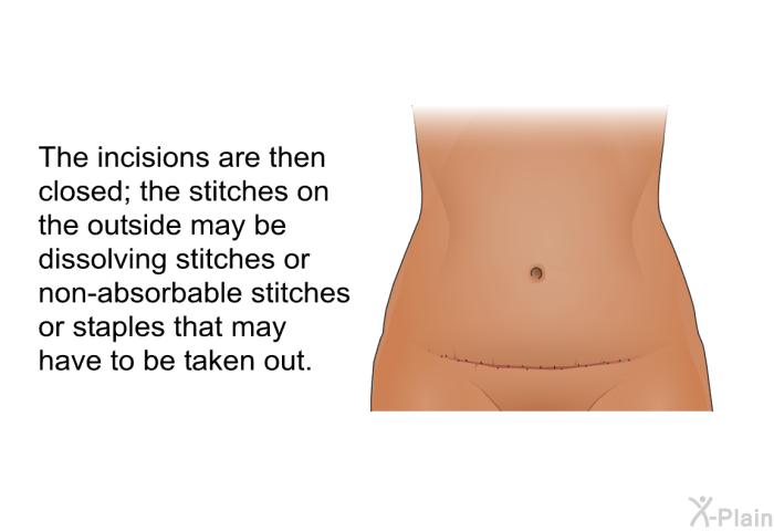 The incisions are then closed; the stitches on the outside may be dissolving stitches or non-absorbable stitches or staples that may have to be taken out.