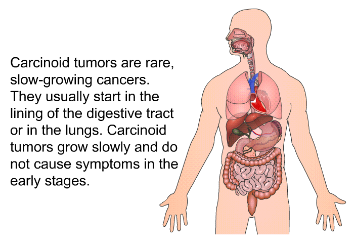Carcinoid tumors are rare, slow-growing cancers. They usually start in the lining of the digestive tract or in the lungs. Carcinoid tumors grow slowly and do not cause symptoms in the early stages.