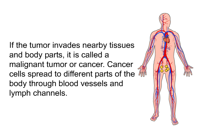 If the tumor invades nearby tissues and body parts, it is called a malignant tumor or cancer. Cancer cells spread to different parts of the body through blood vessels and lymph channels.