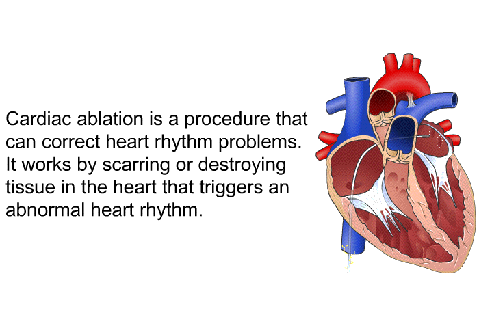 Cardiac ablation is a procedure that can correct heart rhythm problems. It works by scarring or destroying tissue in the heart that triggers an abnormal heart rhythm.