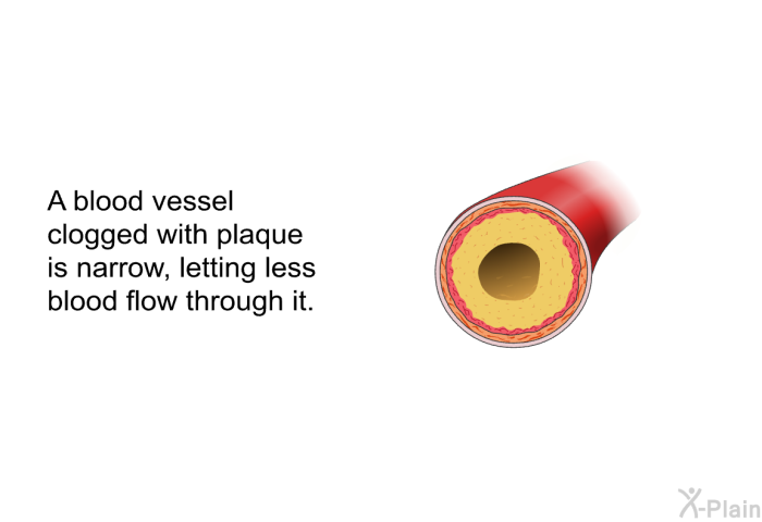 A blood vessel clogged with plaque is narrow, letting less blood flow through it.