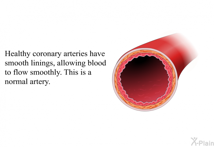 Healthy coronary arteries have smooth linings, allowing blood to flow smoothly. This is a normal artery.