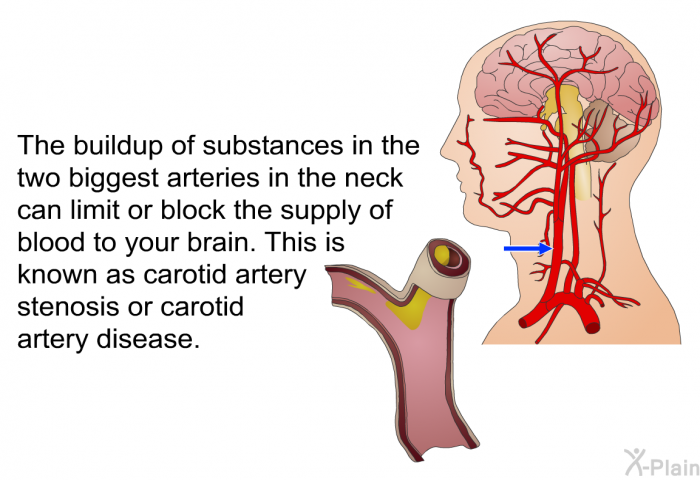 The buildup of substances in the two biggest arteries in the neck can limit or block the supply of blood to your brain. This is known as carotid artery stenosis or carotid artery disease.