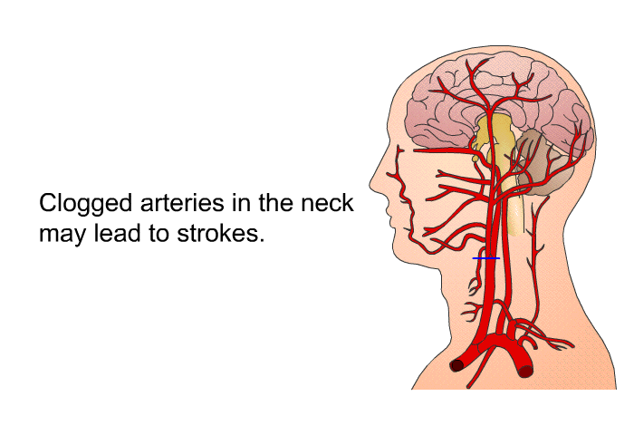 Clogged arteries in the neck may lead to strokes.