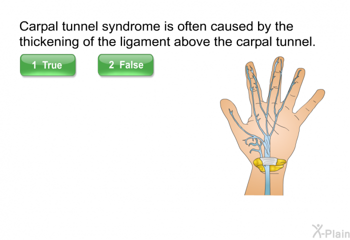 Carpal tunnel syndrome is often caused by the thickening of the ligament above the carpal tunnel. Press True or False