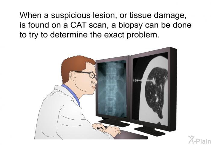 When a suspicious lesion, or tissue damage, is found on a CAT scan, a biopsy can be done to try to determine the exact problem.