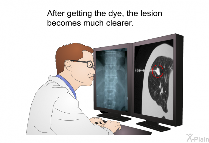 After getting the dye, the lesion becomes much clearer.
