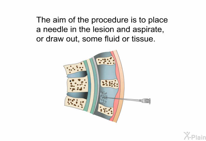 The aim of the procedure is to place a needle in the lesion and aspirate, or draw out, some fluid or tissue.