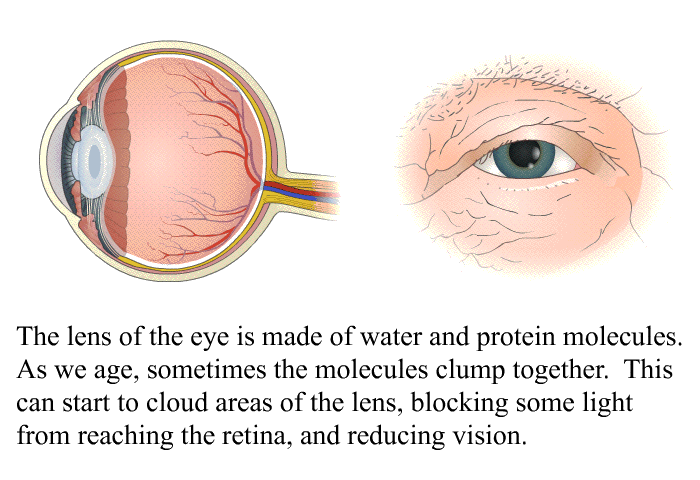 The lens of the eye is made of water and protein molecules. As we age, sometimes the molecules clump together. This can start to cloud areas of the lens, blocking some light from reaching the retina, and reducing vision.