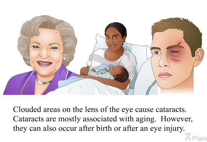 Clouded areas on the lens of the eye cause cataracts. Cataracts are mostly associated with aging. However, they can also occur after birth or after an eye injury.