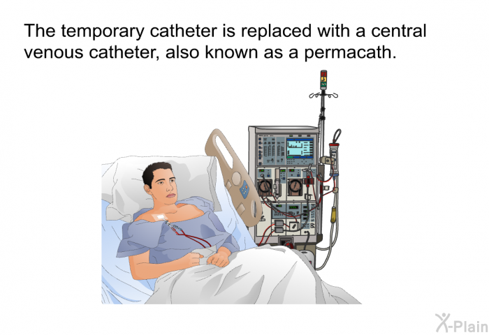 The temporary catheter is replaced with a central venous catheter, also known as a permacath.