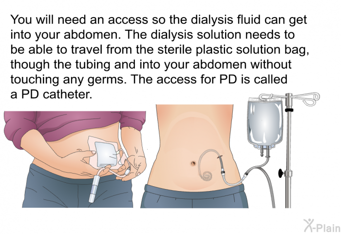 You will need an access so the dialysis fluid can get into your abdomen. The dialysis solution needs to be able to travel from the sterile plastic solution bag, though the tubing and into your abdomen without touching any germs. The access for PD is called a PD catheter.
