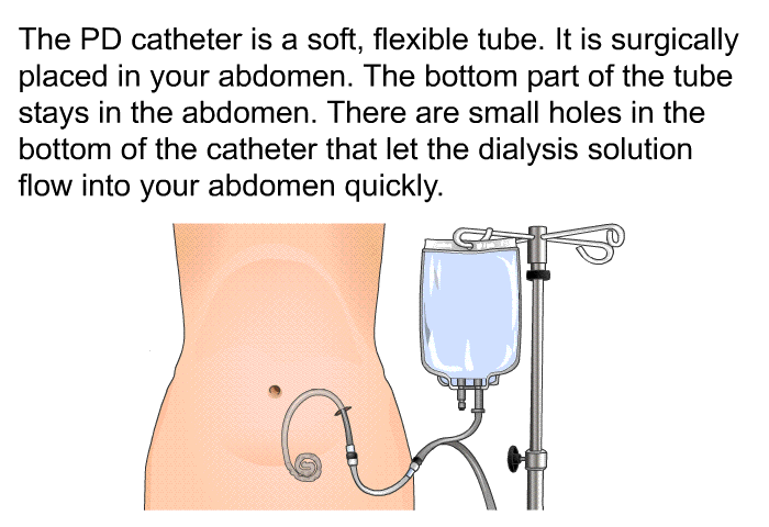 The PD catheter is a soft, flexible tube. It is surgically placed in your abdomen. The bottom part of the tube stays in the abdomen. There are small holes in the bottom of the catheter that let the dialysis solution flow into your abdomen quickly.