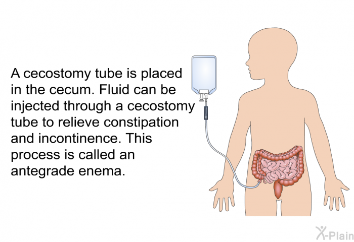 A cecostomy tube is placed in the cecum. Fluid can be injected through a cecostomy tube to relieve constipation and incontinence. This process is called an antegrade enema.
