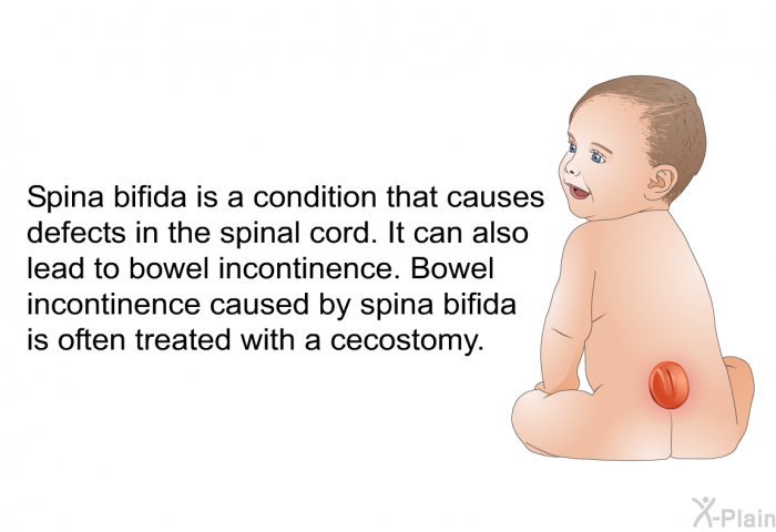 Spina bifida is a condition that causes defects in the spinal cord. It can also lead to bowel incontinence. Bowel incontinence caused by spina bifida is often treated with a cecostomy.