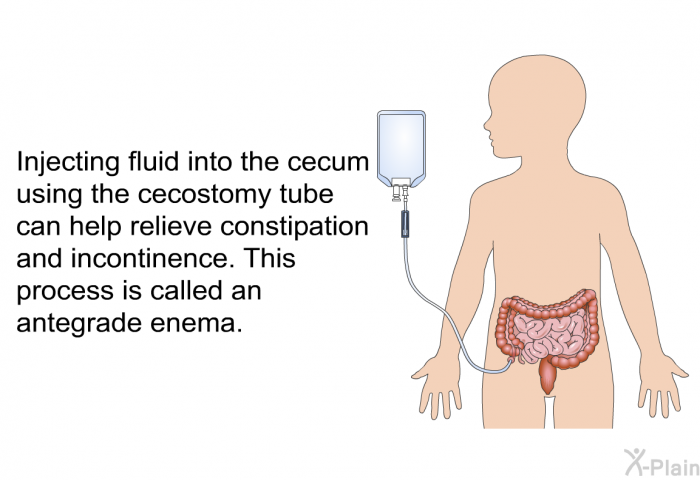 Injecting fluid into the cecum using the cecostomy tube can help relieve constipation and incontinence. This process is called an antegrade enema.