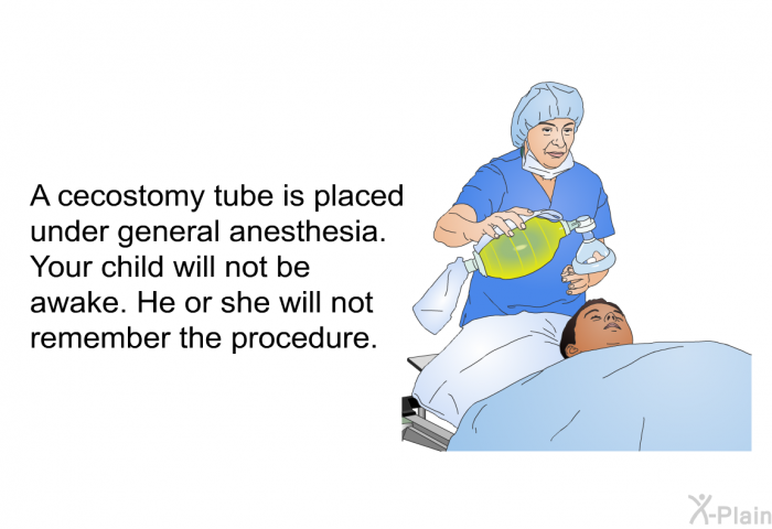 A cecostomy tube is placed under general anesthesia. Your child will not be awake. He or she will not remember the procedure.